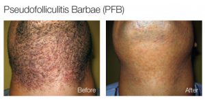 painless-laser-hair-removal-before-and-after-photos