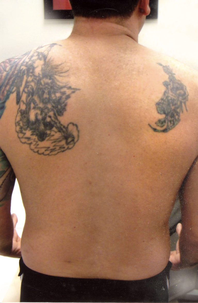 Atlantic Laser Tattoo Removal Tattoo CoverUps and