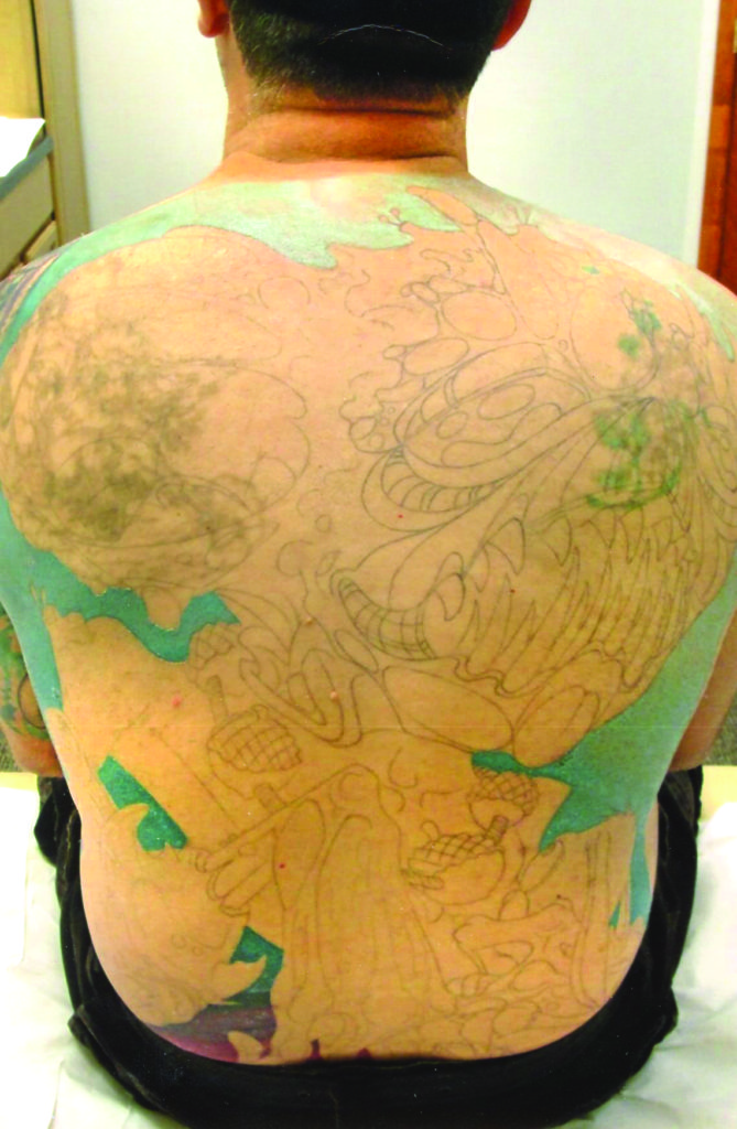 Atlantic Laser Tattoo Removal Tattoo Removal Before and After Photos