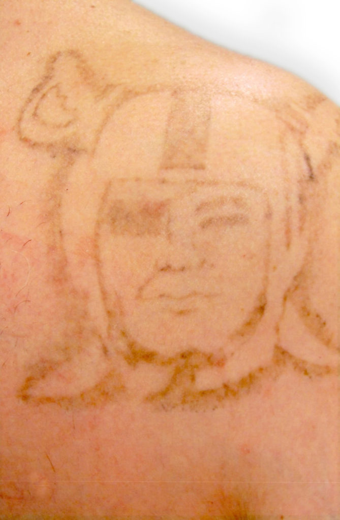 Atlantic Laser Tattoo Removal Tattoo CoverUps and