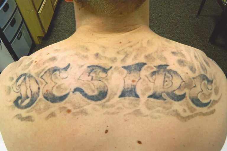 Atlantic Laser Tattoo Removal Tattoo CoverUps and