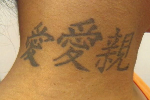 Tribal Tattoo Completely Removed with Lasers Before  After Photos New  Jersey  Reflections Center
