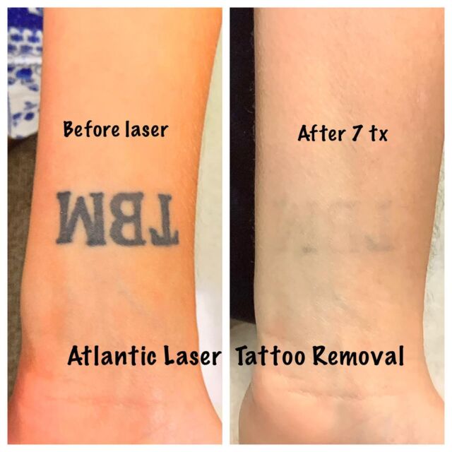 Atlantic Laser Tattoo Removal Tattoo Cover Ups And Tattoo Removal Atlantic Laser Tattoo Removal Tattoo Cover Ups And Tattoo Removal