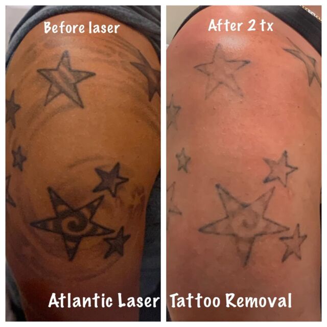 Atlantic Laser Tattoo Removal Tattoo Cover Ups And Tattoo Removal Atlantic Laser Tattoo Removal Tattoo Cover Ups And Tattoo Removal