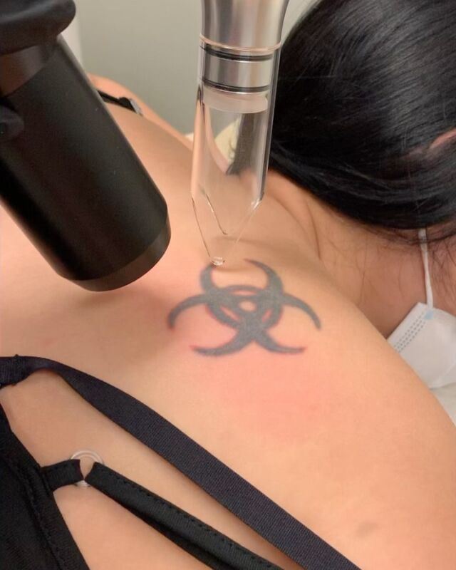 Atlantic Laser Tattoo Removal Tattoo Removal Alternatives Atlantic Laser Tattoo Removal Tattoo Removal Alternatives