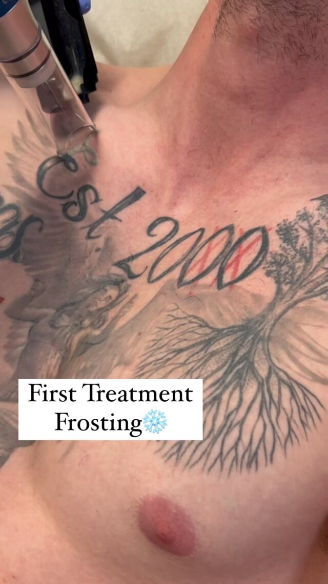  Removery Tattoo Removal  Fading Milton ON  Cylex Local Search