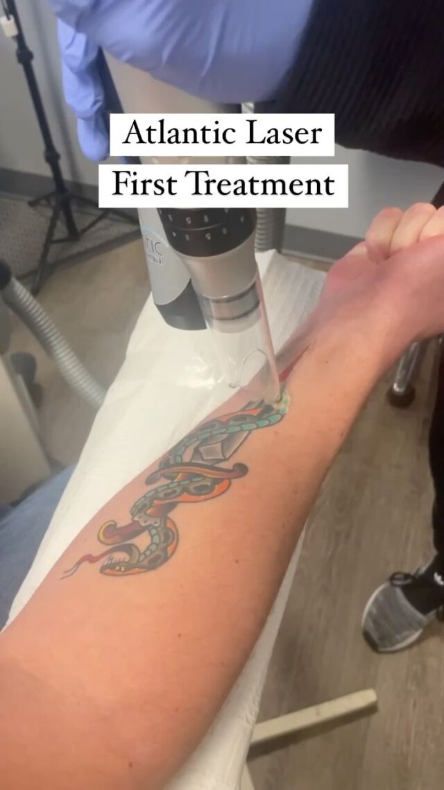 Atlantic Laser Tattoo Removal - Tattoo Removal Alternatives Atlantic Laser Tattoo Removal - Tattoo Removal Alternatives