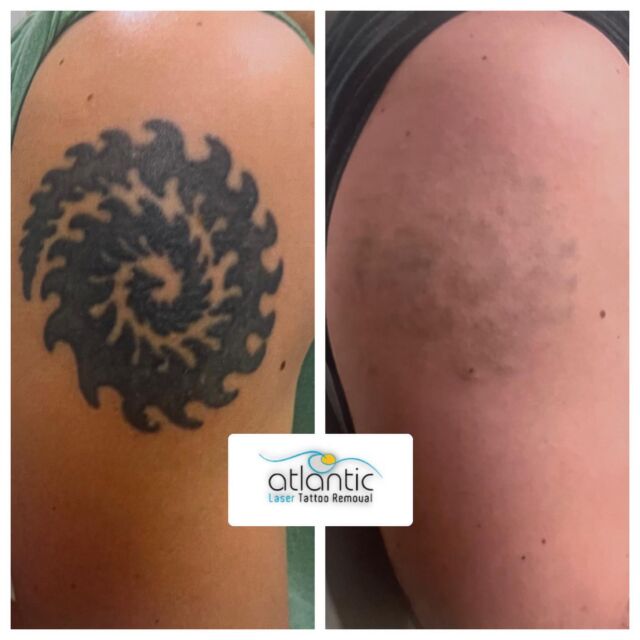 Atlantic Laser Tattoo Removal - Tattoo Removal Alternatives Atlantic Laser Tattoo Removal - Tattoo Removal Alternatives
