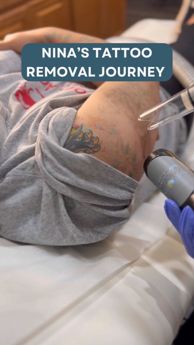 PicoWay treats multicolored tattoos on different skin types PicoWay  utilizes unique picosecond laser technology to deliver fast comfortable  treatments  more than any other traditional laser tattoo removal solution  available  Picture